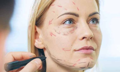 Ultimate guide to facelift treatment- Everything you need to know