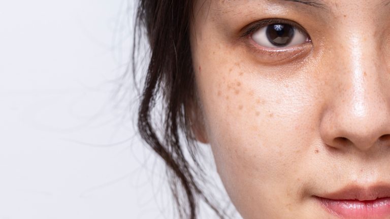 Hyperpigmentation: How To Free The Facial Skin?